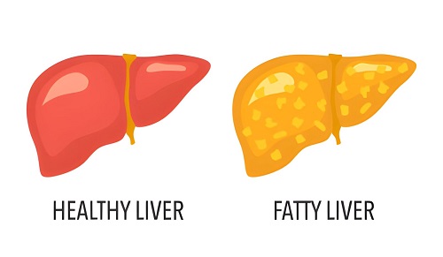 Best Fatty Liver Treatment in Byculla